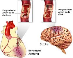stroke dan jantung