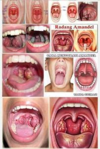 Amandel 2 sembuh oleh milagros